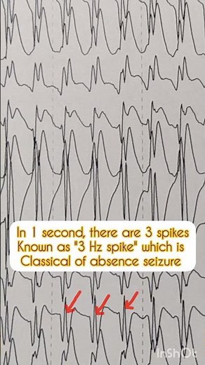 Classical 3-Hz spike EEG discharges in Absence seizures! #mbbs #medicine #neurology