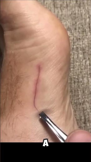 🩺 Doctor Reacts to a MASSIVE Hair Splinter! 🩺