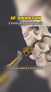Cervical spondylosis 3D Animation #medical #doctor #3danimation #implant | T.Medical.V