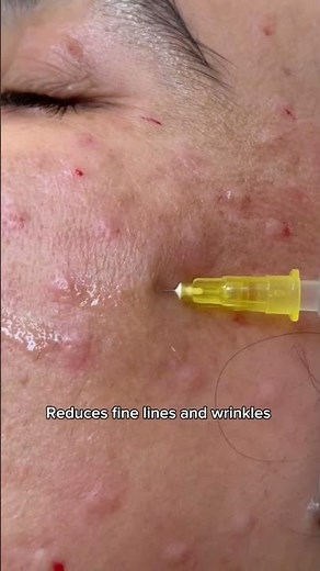 Mesotherapy: The Vitamin Injection Your Skin Needs