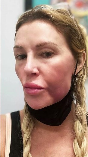 Brandi Glanville Says Her Facial Parasite Came From Ruptured Breast Implants