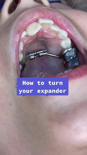 Palatal expansion! #dentist #learnontiktok #braces #expander #orthodontist