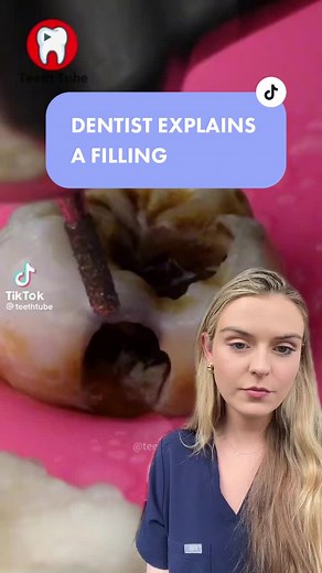 Understanding Deep Filling Procedures by a Dentist