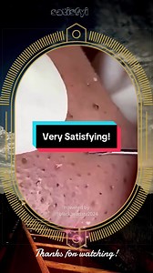Squeeze Popping Acne Pimple Satisfying Abcess Blackheads Removal Pimple Removal | Viral #blackheadsremoval #cleanskin #acnetreatment #pimplepopping #fyp @BlackheadsTV