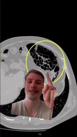 O Segredo da Pneumatose na Tomografia de abdome