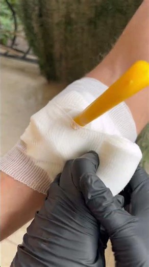 What to Do I get Stabbed – First Aid Steps That Save Lives