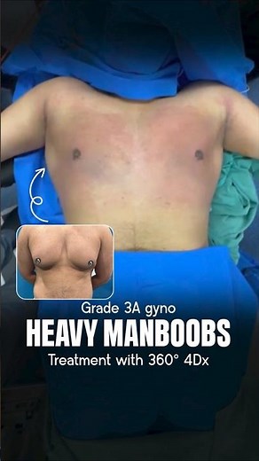 From Heavy Chest to Masculine Contour | Grade 3A Gynecomastia 360° 4Dx Surgery | ManBoobs Treatment