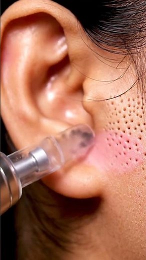 Extreme Ear Blackhead Vacuum | Satisfying ASMR Suction Sounds #facials #blackheadcaique #coldwax