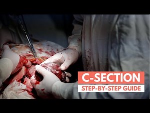 What to expect during a C-section | Real Footage