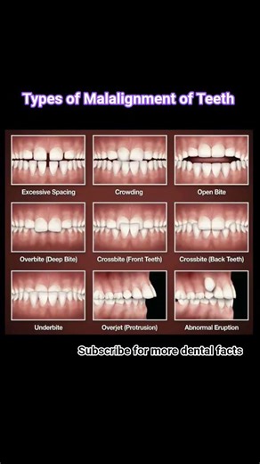 #types of malocclusion of tooth#orthodontic problem#oralhealthcare #healthtips