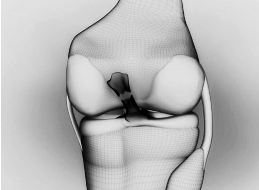 How to Tell if You Tore Your ACL?