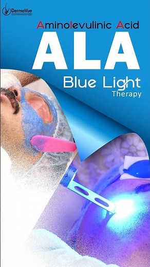 🧬Aminolevulinic Acid Blue Light Therapy: A Powerful Solution for Clear & Healthy Skin 🧬 ‪@DermaVue‬