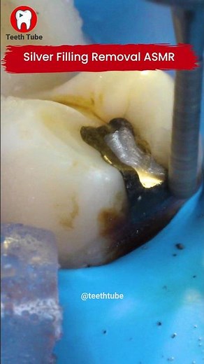 Silver Filling Removal 4k #shorts