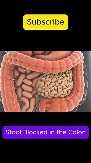 How Stool Travels & Gets Blocked in the Colon #StoolMovement