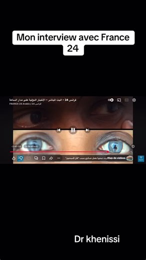 Dre Khenissi Zaineb on Instagram: "#viralreels #foryoupage #fyp #instagood #skincare #france24#foryoupage La kératopigmentation est à l’origine une technique médicale, utilisée pour corriger certains défauts de la cornée, camoufler des cicatrices ou redonner une apparence plus harmonieuse à un œil traumatisé. Mais aujourd’hui, elle est souvent détournée à des fins purement esthétiques, pour changer artificiellement la couleur des yeux. Cette intervention consiste à injecter un pigment directemen