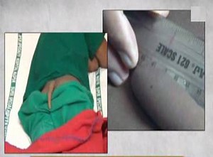 18cm long human tail removed surgically from 18-year-old boy | The Times of India