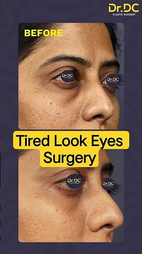 See the Change! Under Eye Bag Surgery Results Timeline | Dr DC, Plastic Surgeon | Pune
