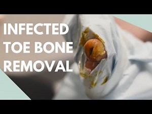 INFECTED TOE BONE REMOVAL