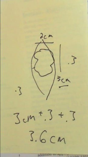 Measuring lesions for excision code selection in CPT - #shorts