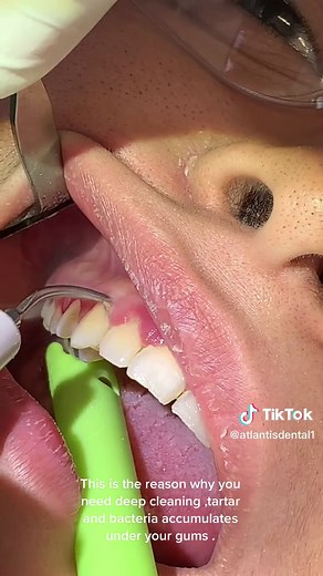Deep Teeth Cleaning for Healthy Gums