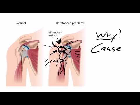 What's The Secret To Fixing Shoulder Tendonitis?