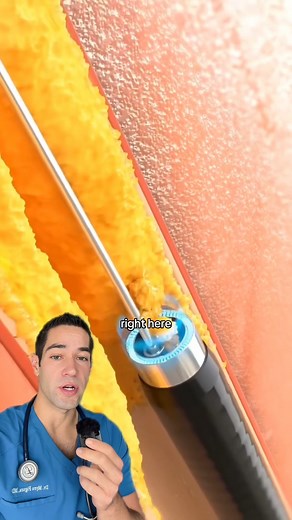 Heart attack of the leg #medicalprocedure #interesting #heartattack #redmeat #bacon #nutrition #doctor #healthtip | Doctor Myro