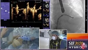 Transcatheter Edge-to-Edge Repair: MitraClip in the Setting of DMR