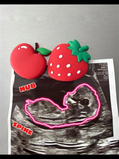 WAIT! ✋ Don’t scroll!! Pink 🎀 or Blue 🍼? 👇 Drop your guess in 3…2…1… This ultrasound fooled 99% of moms 😳🔥 Look closely… the nub tells EVERYTHING 👀 Did you get it right? 👉 Find out in the link in bio #fyp #babytok #genderreveal #ultrasound #pregnancytok