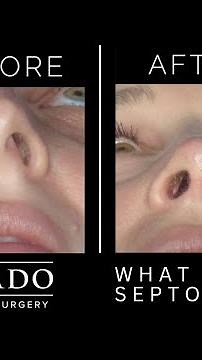 What is a Deviated Septum and How Does a Septoplasty Surgery Help? | Dr. Anthony Corrado