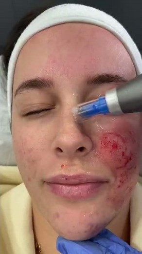 Micro-needling with Dermapen 4 at DRMEDISPA