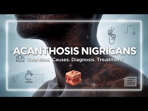 Acanthosis nigricans : Overview . Symptoms . Causes . Diagnosis . Treatment