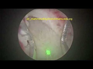 Modified en-bloc resection of a large bladder tumor using Holmium laser.