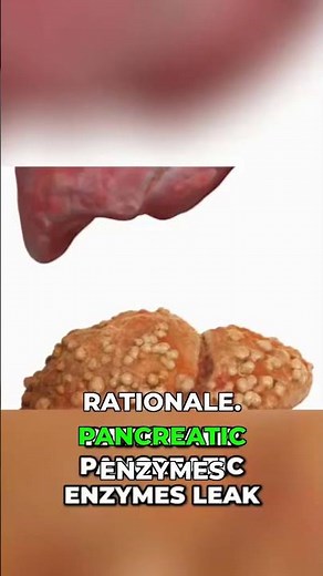 High Amylase & Lipase? Pancreatitis Alert!