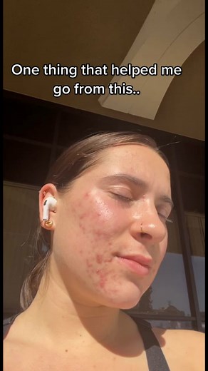 Sunlight helps treat acne, heal inflammation, create vitamin D, regulate the immune system and more! #acne #help #clearskin #health #happy #skincare #skincareroutine #sunlight