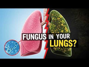 Fungal Pneumonia: The Hidden Lung Infection You Need to Know