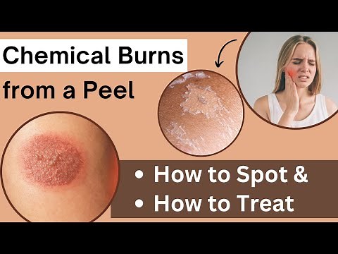 How to Deal with Chemical Burns from Chemical Peels