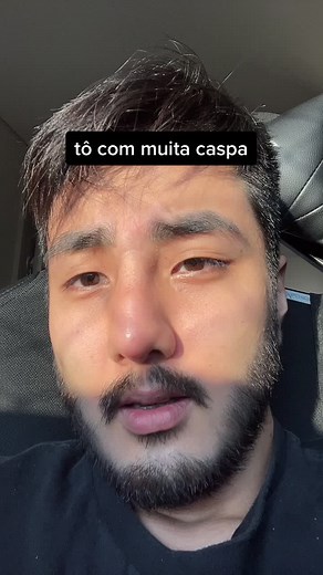 Como Combater a Caspa em Cabelos Masculinos