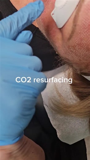 CO2 Resurfacing is a great way to eliminate wrinkles, discolorations and improve tone and texture. #serenerenewal #co2 #co2resurfacing #fractionalco2laser #co2re