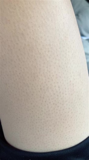 太ももぶつぶつの悩みと解決法