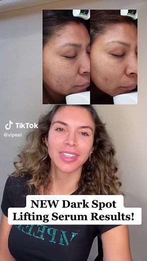 VI Derm Dark Spot Lifting Serum: Before & After Results