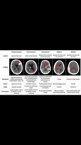 11K views · 182 reactions | 勞✍️Differences between the types of intracranial hemorrhage 易 | Neurology | Facebook