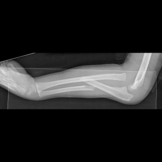Forearm Fractures