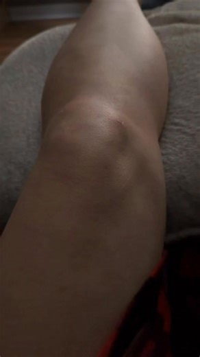 3 weeks post op for the knee surgery/ repair! Micro fractures, blood flow established to regenerate cartilage. Debris/ bone removed. Lots of things fixed! Then we had a surprise of a blood clot! This is all 3 weeks after shoulder surgery where I had a rotator cuff repair, labrum repair, And torn bicep repair! Yes all that within 30 days.,. I was at my breaking point of losing my mind then I started pushing myself harder than I ever have. I’m actually walking with a hinged knee brace, and I’m abl