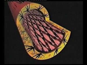 Arterienverkalkung - Lehrvideo der Dr Rath Gesundheitsallianz