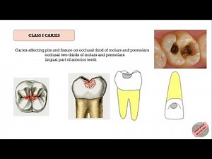 Quick Revision of G. V. Black's Classification of Dental Caries