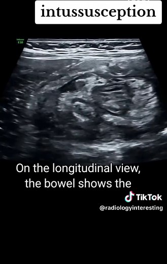Understanding Intussusception on Ultrasound Imaging