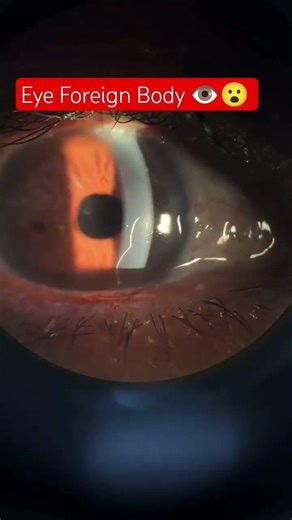 foreign body| #eyecare #eyehealth #eyetest #foreginbody #eyeexam #eyetest #optometry #slitelampexam
