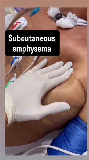 Pure medicine on Instagram: "CLINICAL EXAMINATION OF SUBCUTANEOUS EMPHYSEMA ✨ One of the most striking findings in a physical exam is subcutaneous emphysema—when air escapes into the subcutaneous tissues and spreads beneath the skin. The clinical examination is often the key to spotting it early. During assessment, the first clue is usually visible swelling, often around the chest, neck, or face. But the hallmark sign appears on palpation: a distinctive crepitus, a crackling or popping sensation