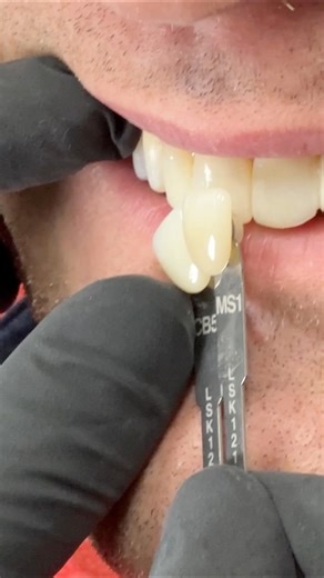 Custom shade matching on-site in my lab using my Chairside Shade Guide 8.0 cosmetic shade matching tool | Luke Kahng