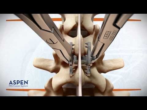 ASPEN® MIS Fusion System -- Procedure Animation